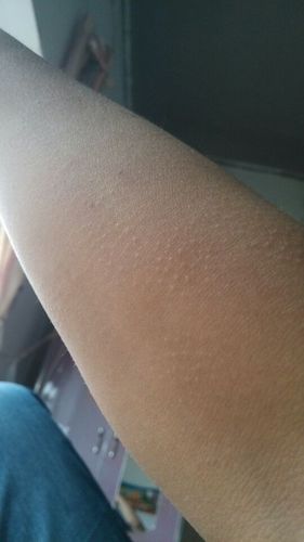 我的手上长出鸡皮疙瘩一样的痘痘