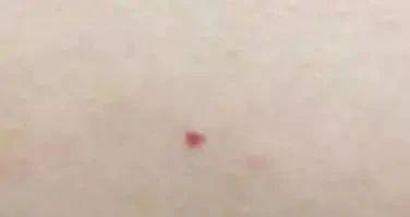 皮肤不隆起.不痛不痒.有可提示凝血功能发生了异常