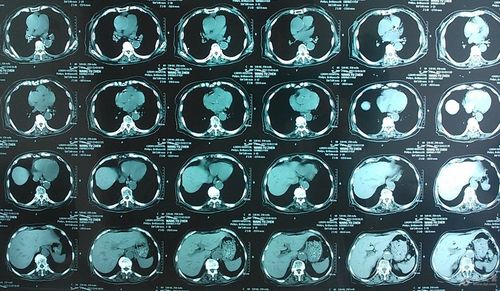与ct相比胸片会漏掉很多信息有意想不到的进展