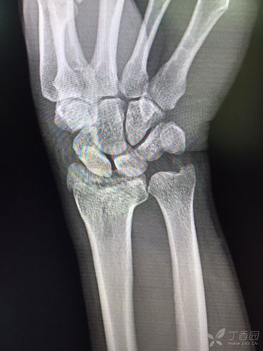 桡骨远端骨折是否能手法复位成功?有没有手术指征? [病例帖]