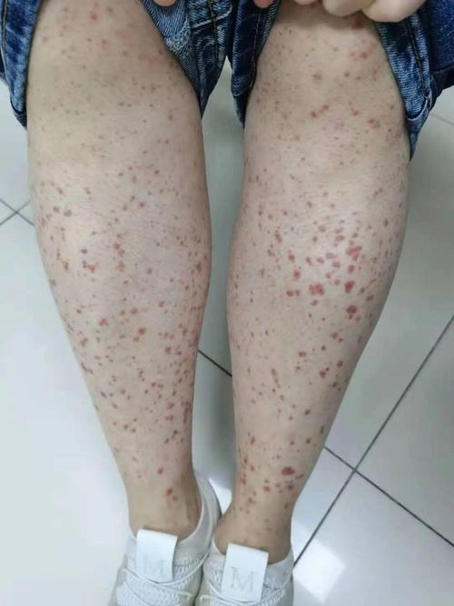 大人小孩都会得,看似皮肤过敏,竟然是一种血液病?专家