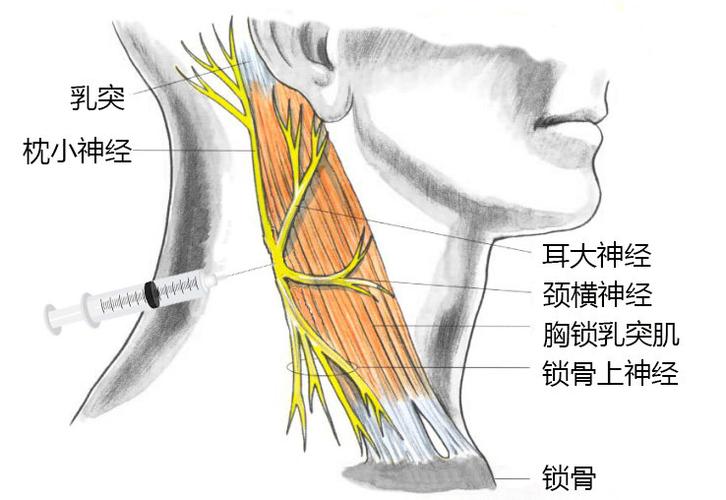 确定胸锁乳突肌后缘中点,约相当于c4横突水平.
