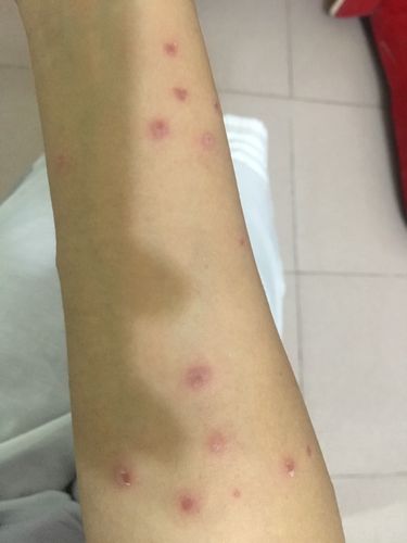 这种是湿疹还是水痘还是什么,一开始两只手臂上,现在腿上也长了,有点