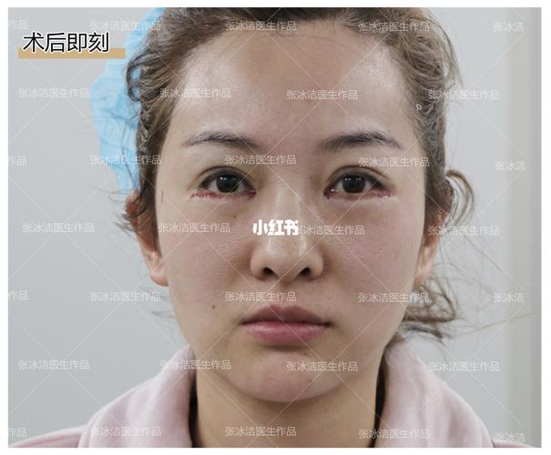 眼袋修复-卧蚕消失-卧蚕再造_卧蚕_眼袋_美妆_医美整形
