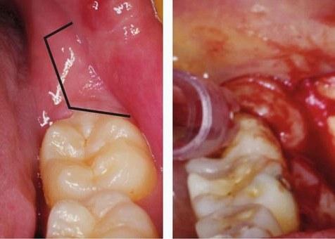 【图】智齿拔除术切口的类型