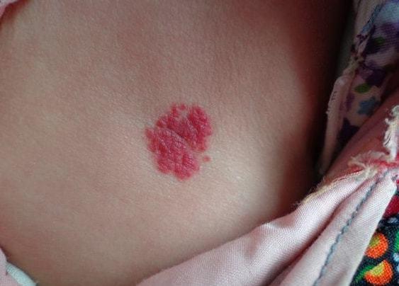 上海曹安医院温馨提示:新生儿身上若是有了可疑的红斑,红点,父母要多