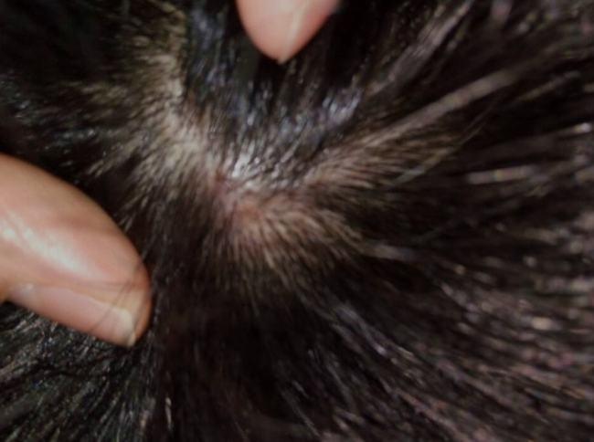 一般我们都很少考虑头皮问题,因为头发里面容易被大家忽视,头皮和大脑