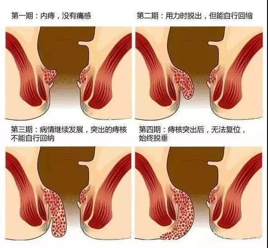"脱肛"脱出的小尾巴,是直肠还是痔疮?