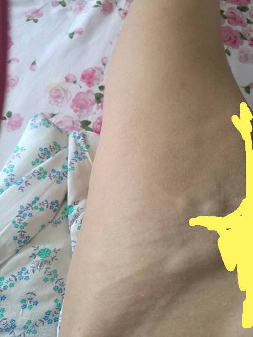 大腿腹部连接处淋巴结有肿块,要紧吗?