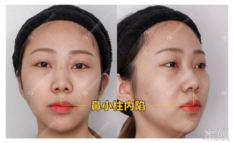 综合隆鼻后,这个鼻小柱内陷的乖乖女,惊现完美鼻尖