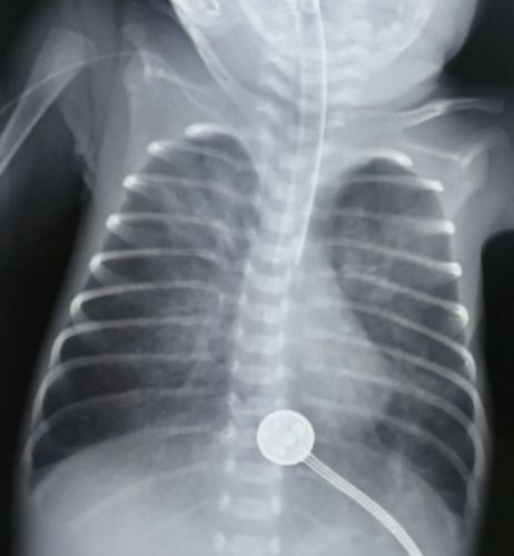 灌洗后当天复查胸片肺不张消失