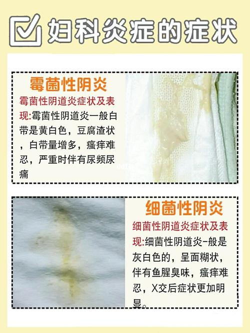 正常的白带是什么样?