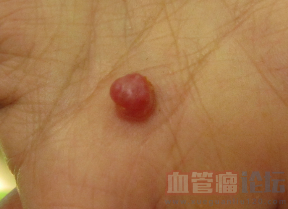 肉芽肿型毛细血管瘤严重吗?怎样治疗?