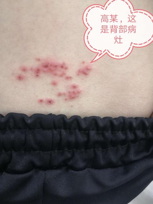 高某,女,16岁.带状疱疹两剑克治疗