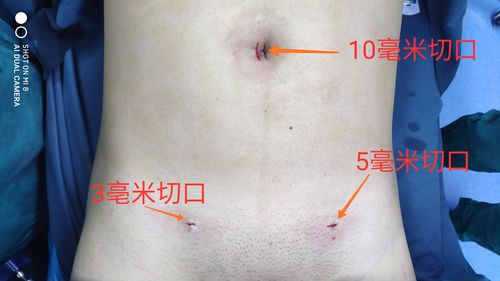 隐瘢痕手术是指把腹