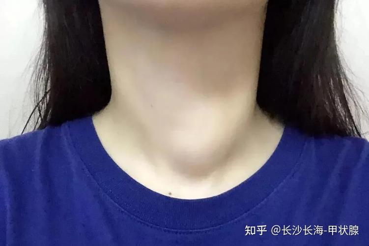 甲状腺肿大,多数是这几个原因造成的