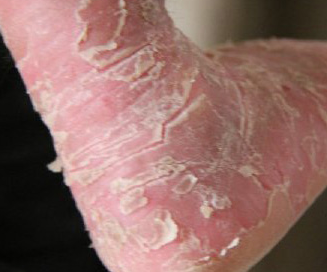 婴儿鱼鳞病症状有哪些