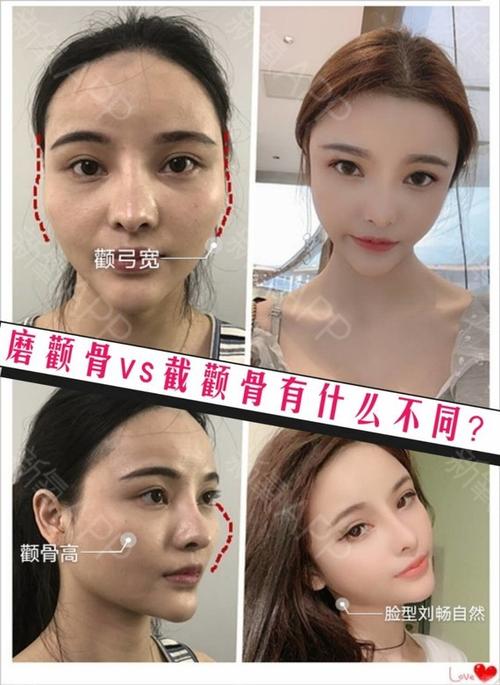磨颧骨vs颧骨内推,这两种手术有何不同,该怎么选