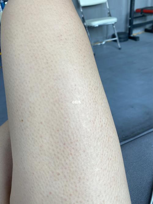 鸡皮肤刷酸6次对比图,真的有效果,开始的时候一周2次