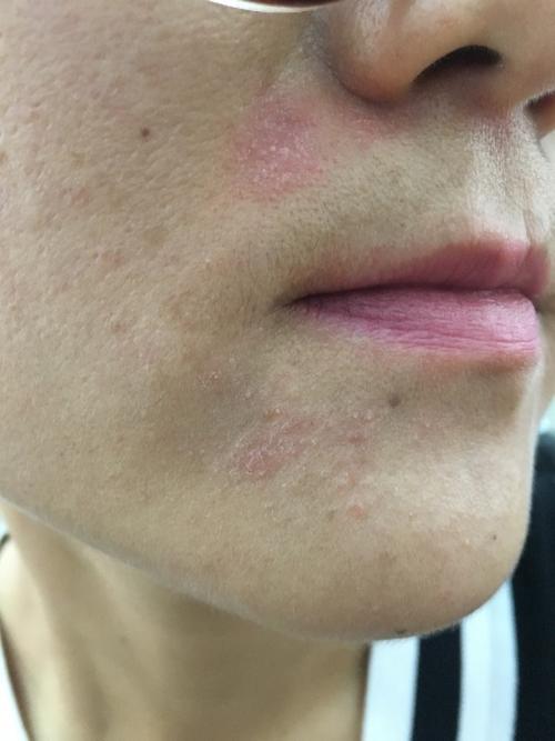 脸上反复长一块藓一样的东西,过两天就起皮,好了又长咋回事