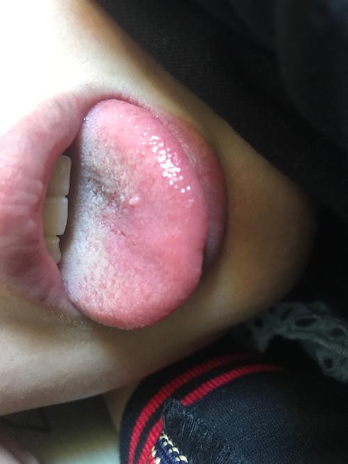 舌头上长了一个白色的肉粒,怀孕五个多月,昨天感冒了
