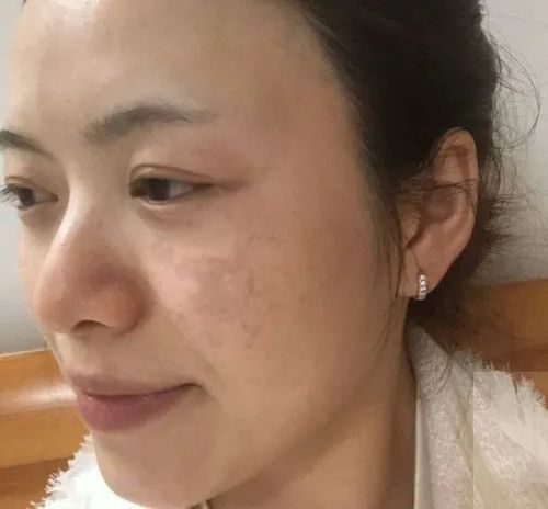 常服逍遥丸会让黄褐斑淡化有黄褐斑的女生建议养成这几个习惯