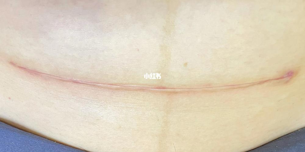 剖腹产20天疤痕_剖腹产_疤痕_母婴_妈妈经验