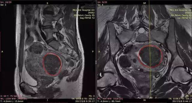 子宫肌瘤为何要做核磁共振检查?