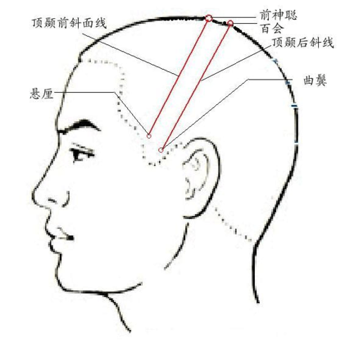 头皮针抽提法治疗中风