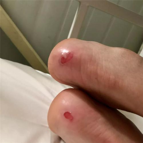 脚后跟长出的血泡都被磨破了.