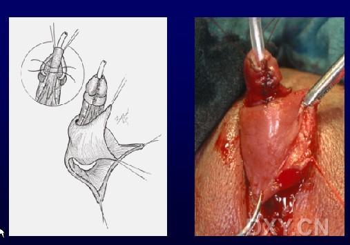 【交流】变性手术过程图片(生殖器官植入部分)