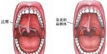 【养生系列之六】扁桃体老发炎,咽炎总不好?