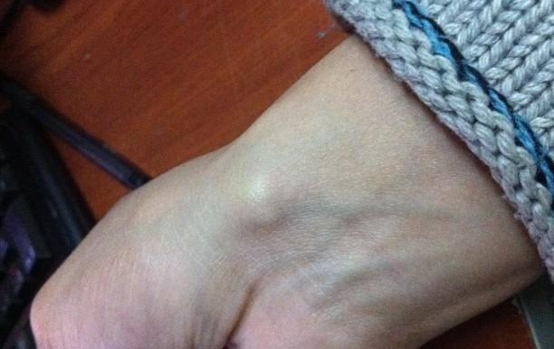 手腕上莫名其妙起了个疙瘩 硬的 不疼 怎么回事儿