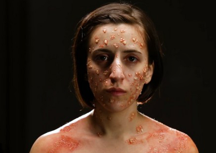 古代天花到底是什么病为何古人如此的害怕天花