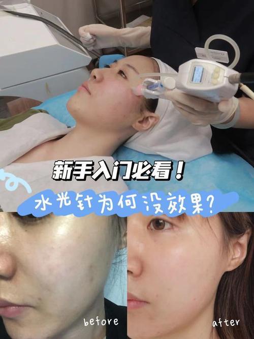 新手入门水光针为何没效果