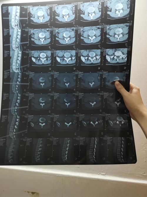 请问有人可以看懂ct吗,可以帮我看看吗