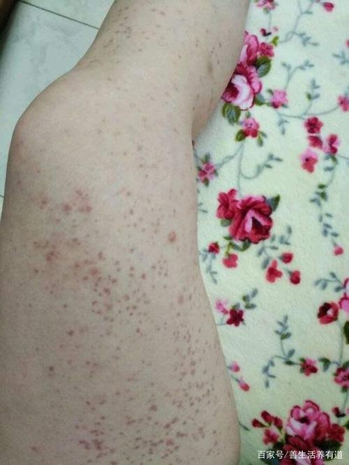 过敏性紫癜的忌口