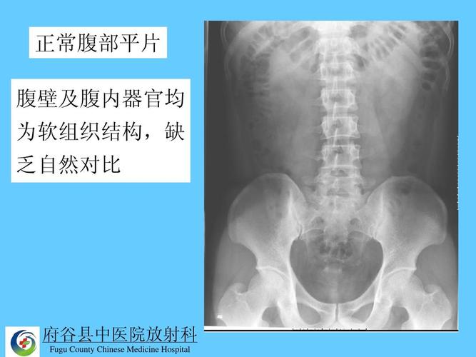 正常腹部平片 腹壁及腹内器官均 为软组织结构,缺 乏自然对比 府谷县