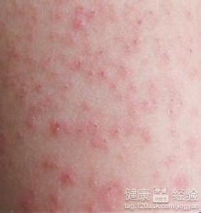 得了丘疹性荨麻疹,长了好多疙瘩,被虫子叮咬后皮肤过敏红肿,并皮肤