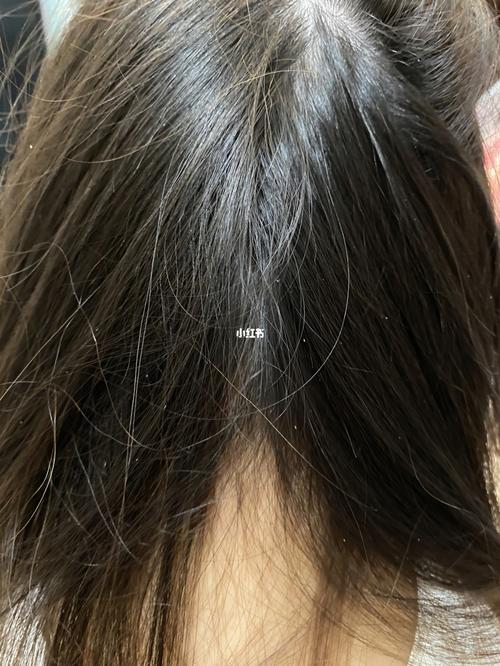 刚洗完头就一堆白点点 这是什么啊_头屑_头皮屑_医疗健康_医疗健康