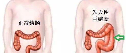 男子"怀胎"29载,腹腔镜手术切除先天性巨结肠!mp.weixin.qq.com