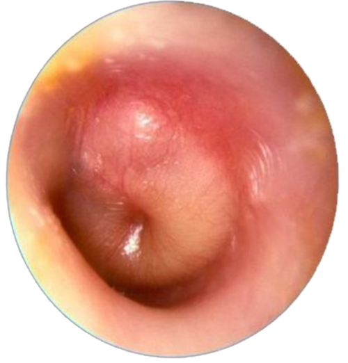 急性化脓性中耳炎 ▲图片来源:google