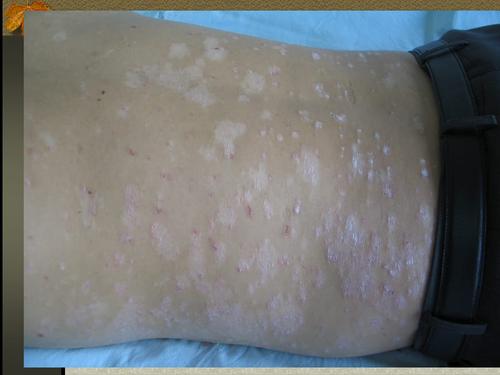 皮肤科(神经性皮炎-湿疹).ppt