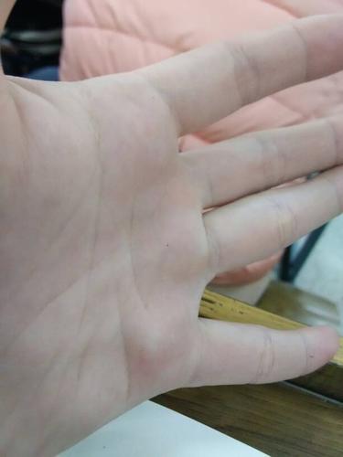 手上长了东西,是不是腱鞘囊肿?医生说是的,不过长在小