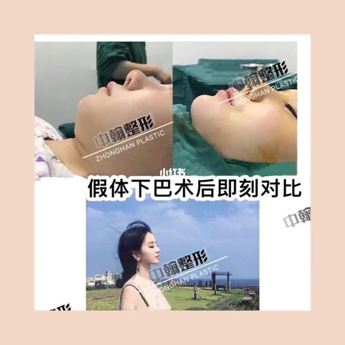 凸嘴,下巴后缩……_下巴后缩_凸嘴_中翰整形美容外科医院自由行热门