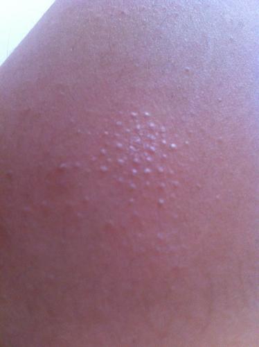 答: 这种出现在胳膊或者是大腿上的是鸡皮肤,又叫毛周角化症,在