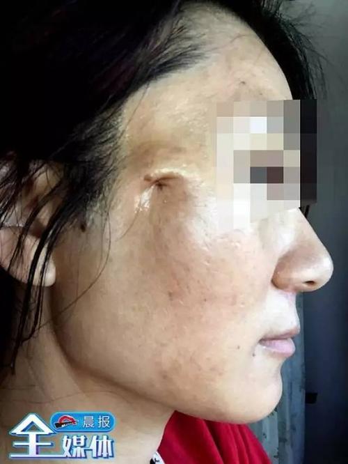 一根钓鱼线也敢往脸上埋?脸部凹陷都算幸运!