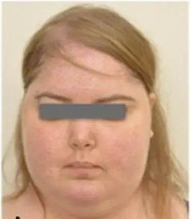 因为需要长期服用激素,药物副作用导致她拉肚子,出现了满月脸,水牛背