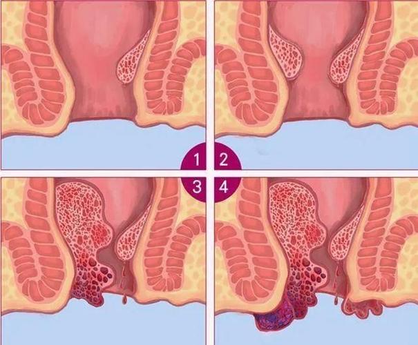齿状线上方为内痔,主要在肛门里面,严重者会脱出肛门;而齿状线下方为