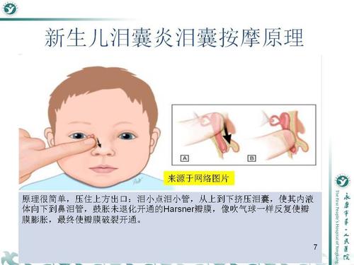 新生儿泪囊炎泪囊按摩手法详解